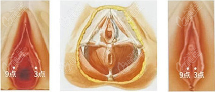 4D生物束带紧缩阴道手术过程