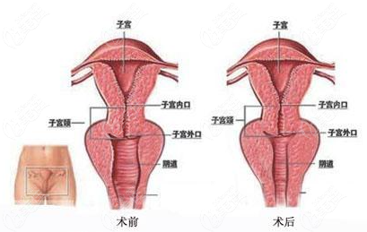 4D生物束带缩阴手术过程