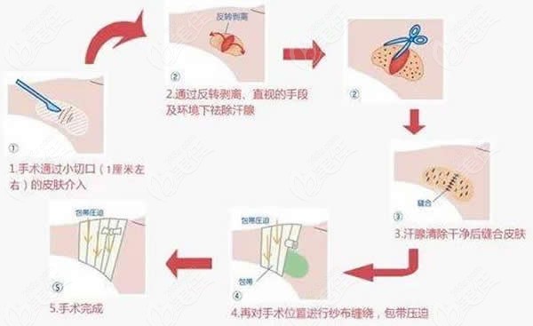 微创祛腋臭的手术过程图