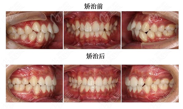 为什么隐形异物感强,为什么隐形异物感强呢