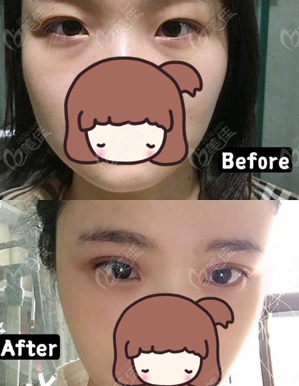 鹿世江医生双眼皮修复前后效果对比