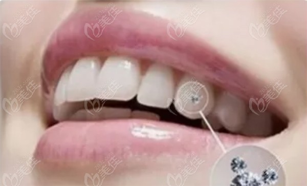 中家医家庭医生口腔的水晶牙钻