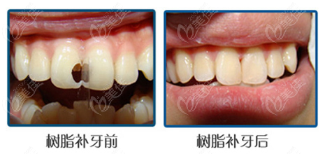 树脂补门牙缝前后图片图片