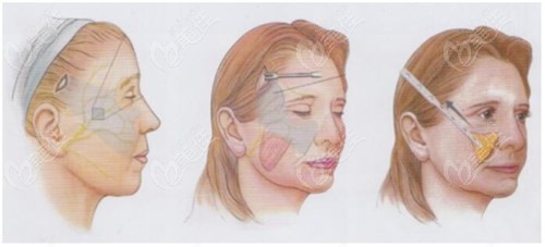 黑龙江超龙面部提升手术过程