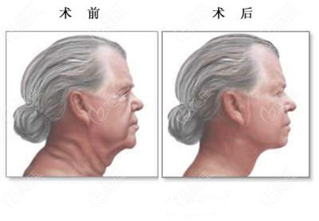 面部拉皮手术过程和真人对比图