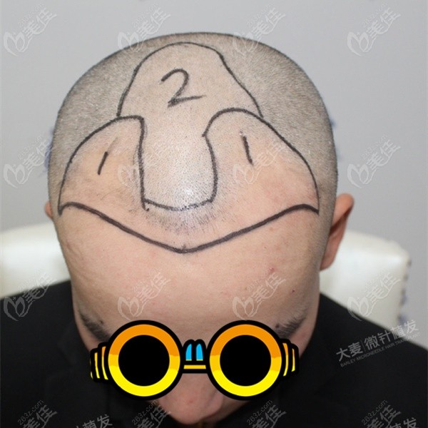 这是我做头顶加密植发前，剃头设计种植方案时的样子
