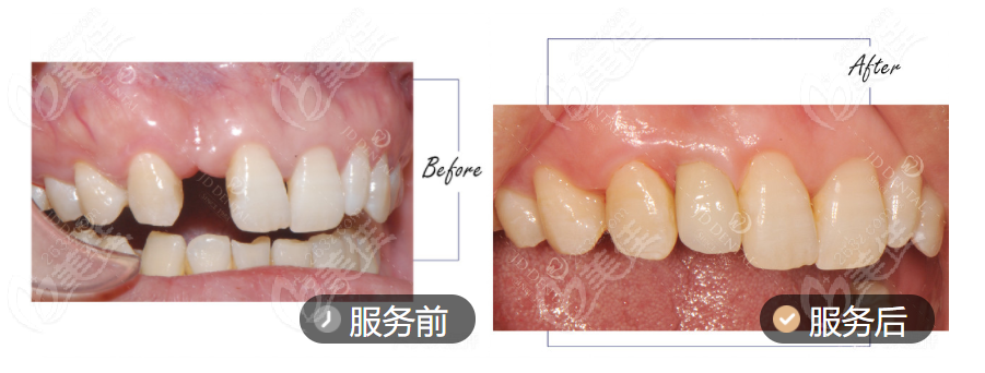 精德口腔微創(chuàng)舒適種植