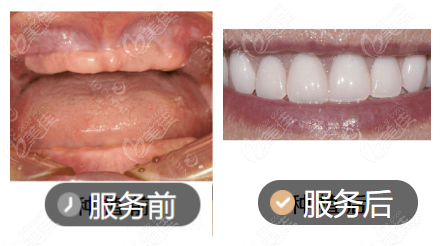 解德勇醫(yī)生全口種植牙修復(fù)