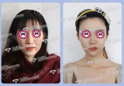 沈阳杏林面部脂肪填充真人对比照