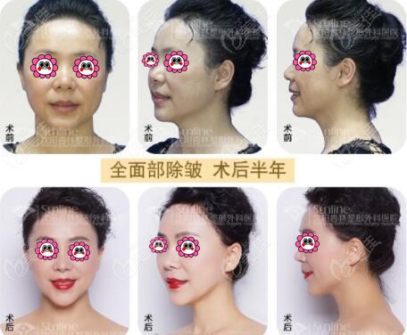 沈阳杏林面部除皱真人对比照
