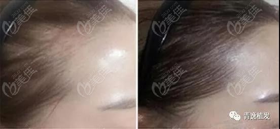 再生发际线的效果展示