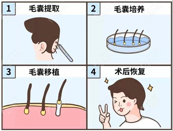 植发手术原理视频(植发手术原理视频教学)