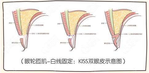 kiss法双眼皮图片