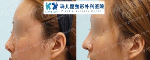 韩国珠儿丽整形外科医院的鼻修复效果