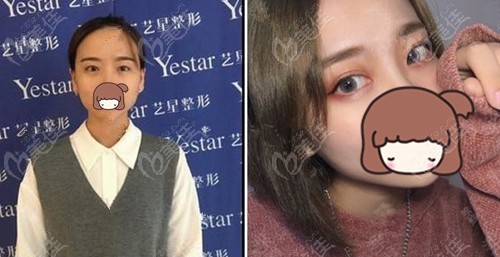 武汉艺星姜涛美杜莎美眼手术