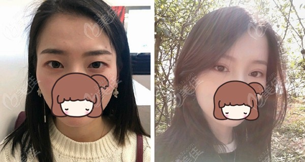 <!--<i data=20240703-sp></i>-->鹿世江眼综合手术