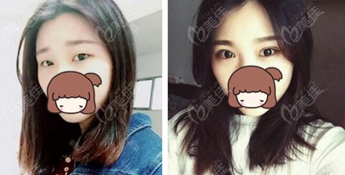 武汉美基元汪洋眼综合手术