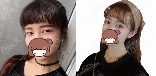 武汉壹加壹付俊俐玖度魅眼手术