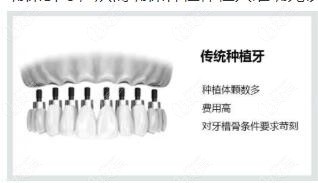 傳統(tǒng)種植牙