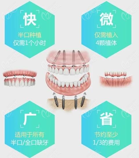 all-on4種植牙優(yōu)勢(shì)