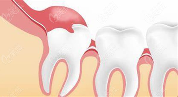 在珠海拔除阻生智齒