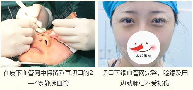 急速纳米美眼术后即刻肿胀不明显
