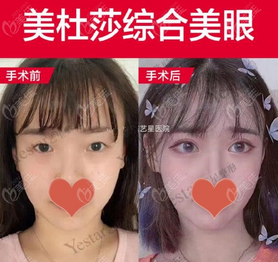 艺星美杜莎综合美眼对比照