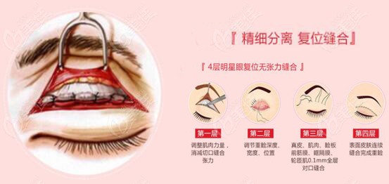 美杜莎双眼皮的精细剥离和无张力缝合技术