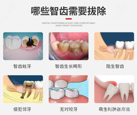 拔智齒的情況分類(lèi)