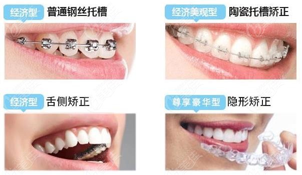 牙齿矫正的几种方式