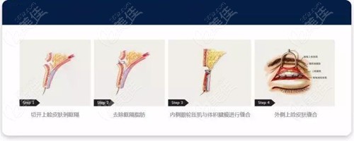 park法双眼皮原理