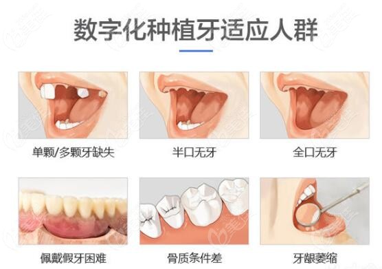 北京科尔口腔数字化种植牙适应症