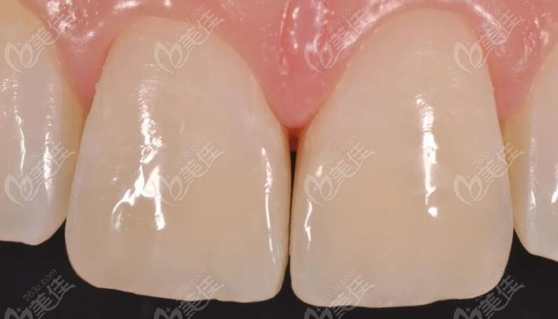 两颗前牙折裂使用3M树脂修复后,美观度似真牙