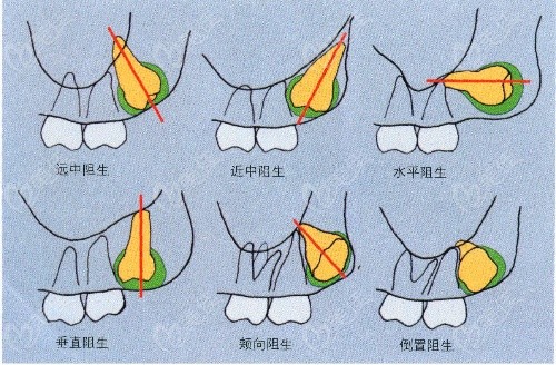 上颌智齿拔除步骤简图图片