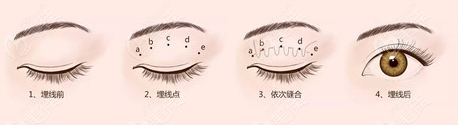 D.F埋线双眼皮手术过程示意图