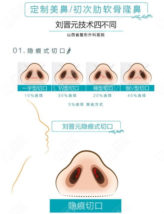 山西省整形外科医院刘晋元鼻综合切口隐蔽