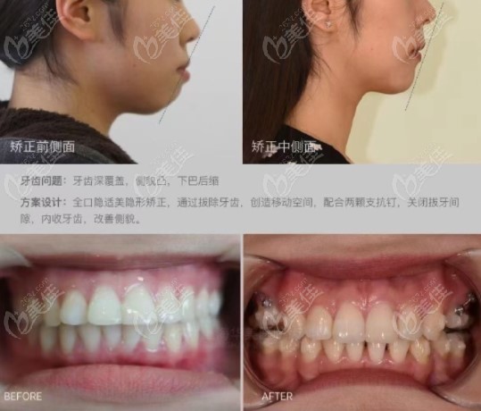深覆合小姐姐的矯正病例，前后臉型變化