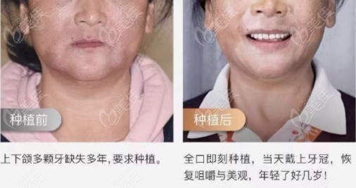全口即刻負(fù)重種植牙前后的對比