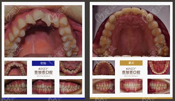 扭转牙的正畸过程图解图片