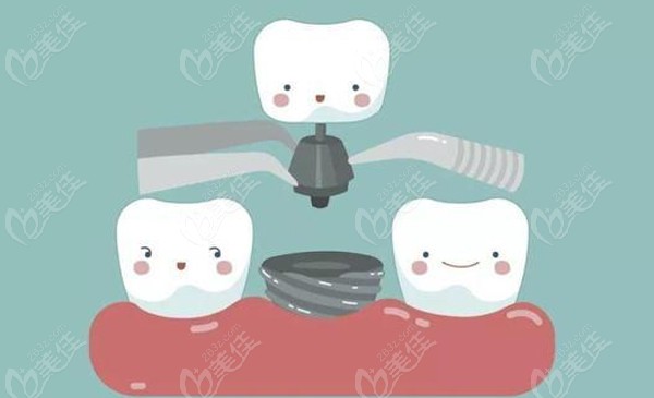 黃岡皓清口腔種植牙的價(jià)格