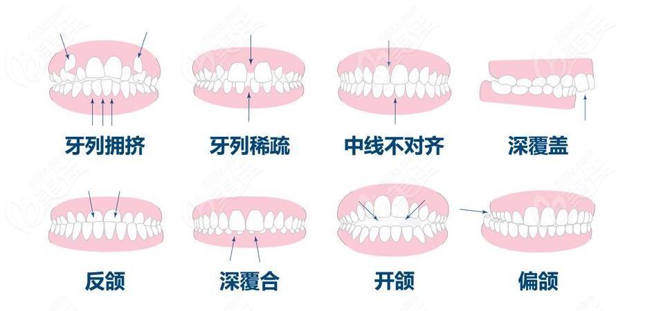 淮安整牙大概多少錢？矯正牙齒去哪家口腔醫(yī)院比較好？