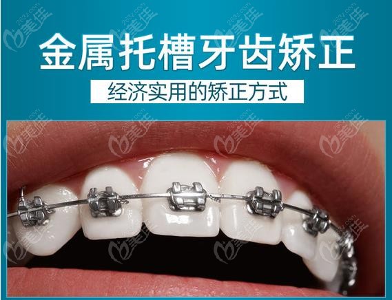 在淮安做金屬鋼絲托槽矯正大概多少錢？