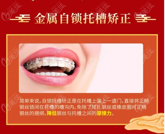 淮安戴金屬自鎖矯正牙套的價(jià)格