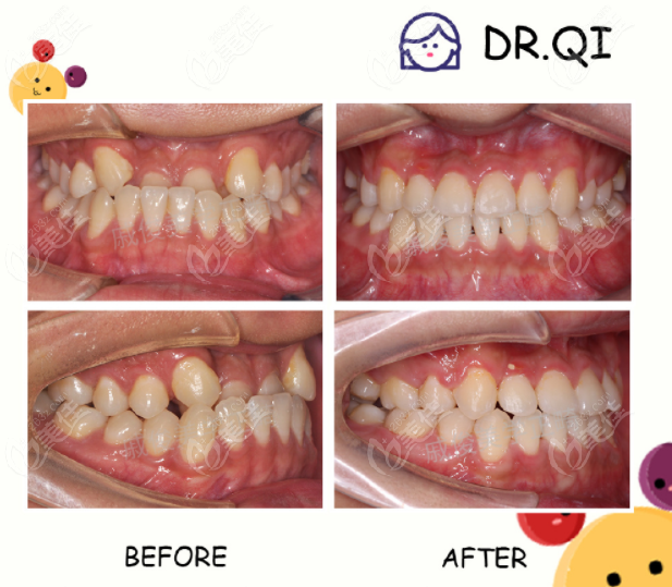 別再說廣州馬瀧齒科為什麼那麼貴了來見識下馬瀧齒科正畸醫生的技術吧
