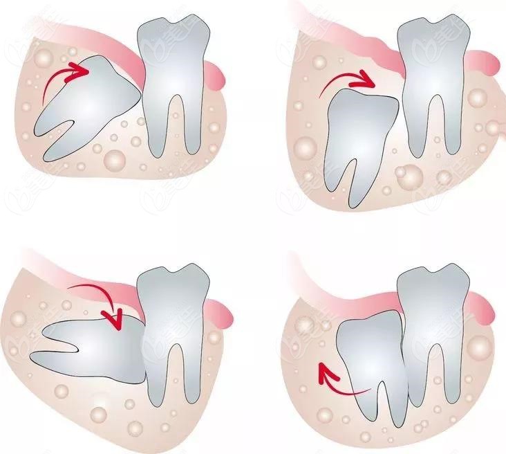 拔除不同位置的牙齿收费也是有差异的,就像智齿,正位已经长出来的智齿