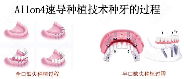 使用allon4种植牙技术做种植牙的过程