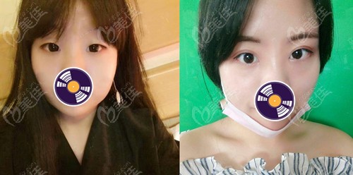 <!--<i data=20240703-sp></li>
<li><i data=20240703-sp></i>-->眼综合效果图