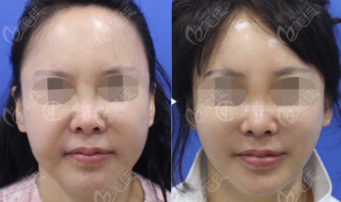 韩国可来熙面部提升正面效果图 韩国可来熙面部提升正面效果图