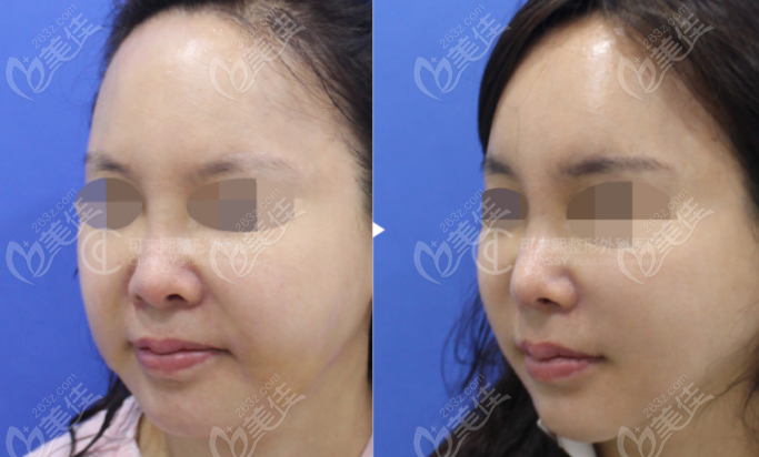 韩国可来熙小切口面部提升45°侧面效果图