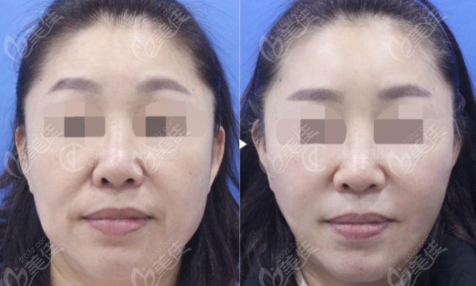 韩国可来熙mini小拉皮手术照片